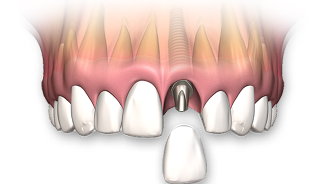 Dentalia smiles